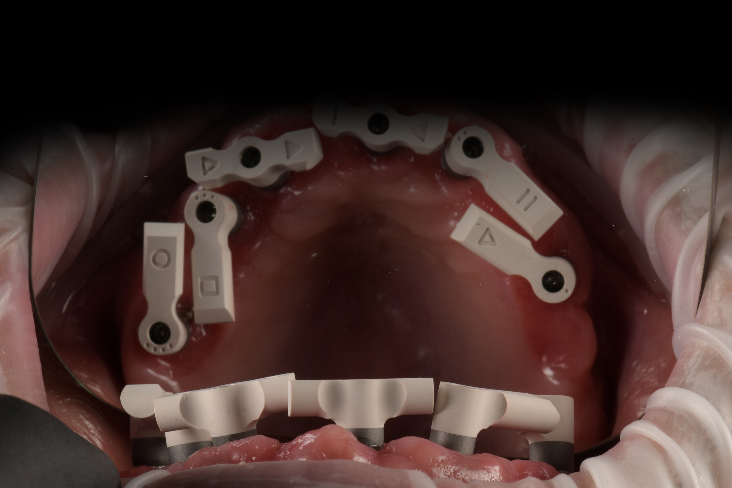 solution for all-on-x multi-implant cases